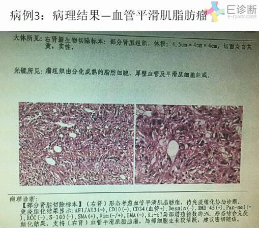 【病例】肾脏肿瘤4例影像诊断与鉴别