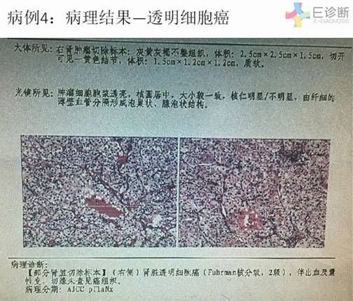 【病例】肾脏肿瘤4例影像诊断与鉴别
