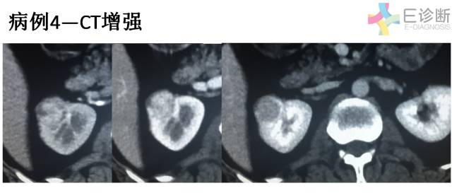 【病例】肾脏肿瘤4例影像诊断与鉴别