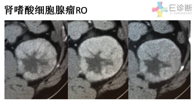 【病例】肾脏肿瘤4例影像诊断与鉴别