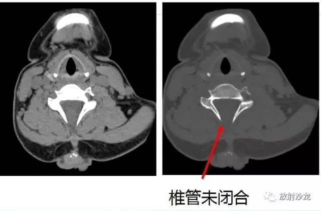【病例】神经管闭合不全+Chiari畸形1例CT及MR 【病例】神经管闭合不全+Chiari畸形1例CT及MR