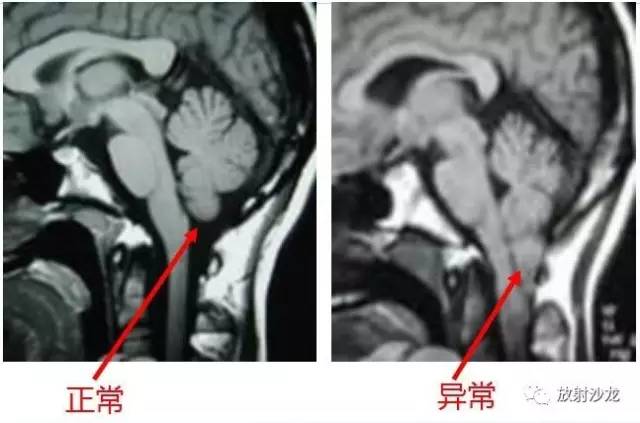 【病例】神经管闭合不全+Chiari畸形1例CT及MR 【病例】神经管闭合不全+Chiari畸形1例CT及MR