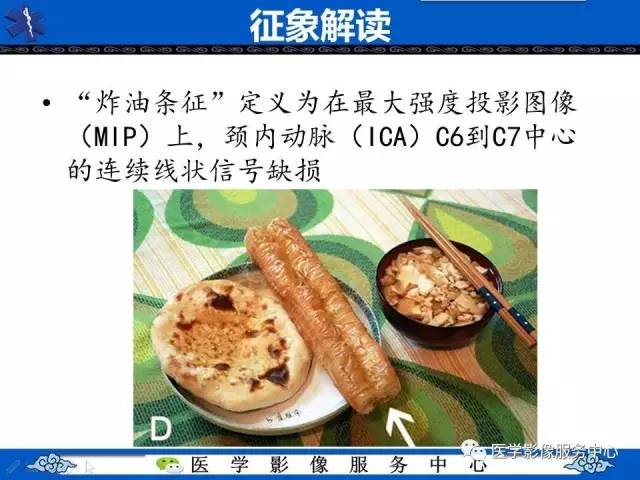 【影像征象】炸油条征