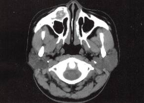 【病例】颌面部骨化性纤维瘤1例CT 【病例】颌面部骨化性纤维瘤1例CT