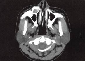 【病例】颌面部骨化性纤维瘤1例CT 【病例】颌面部骨化性纤维瘤1例CT
