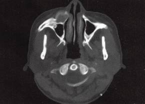 【病例】颌面部骨化性纤维瘤1例CT