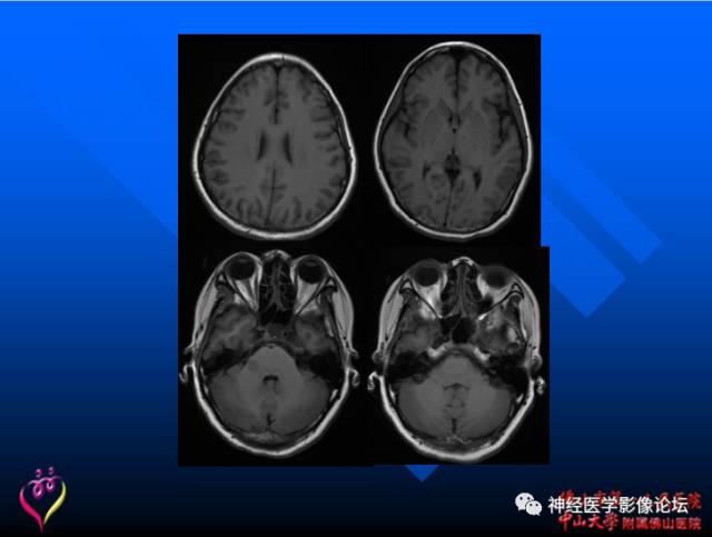 【病例】新型隐球菌脑膜脑炎1例MR