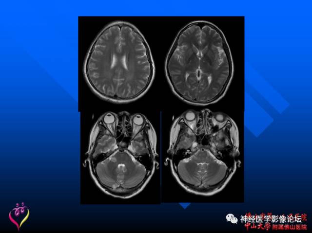 【病例】新型隐球菌脑膜脑炎1例MR