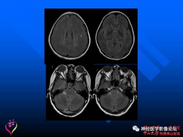 【病例】新型隐球菌脑膜脑炎1例MR