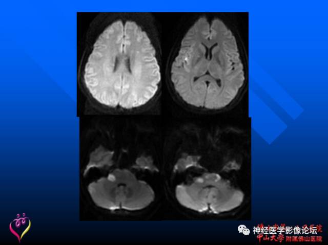 【病例】新型隐球菌脑膜脑炎1例MR