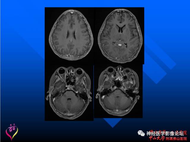 【病例】新型隐球菌脑膜脑炎1例MR