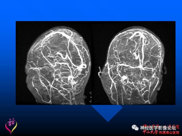 【病例】新型隐球菌脑膜脑炎1例MR