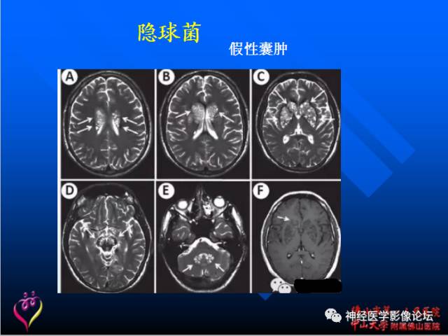 【病例】新型隐球菌脑膜脑炎1例MR