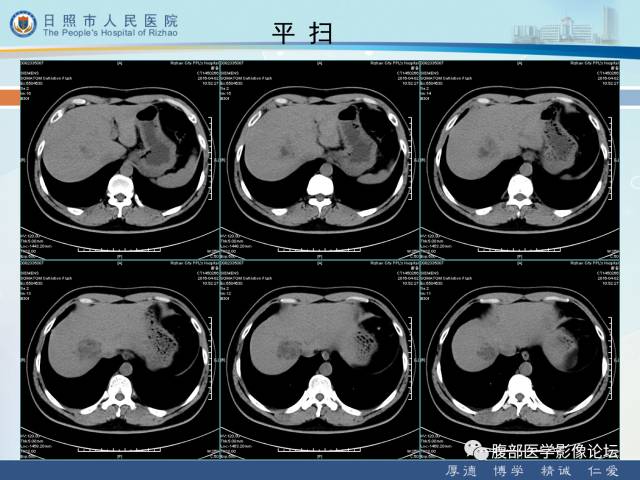 【病例】肝右叶孤立性胆管错构瘤1例CT影像表现 【病例】肝右叶孤立性胆管错构瘤1例CT影像表现
