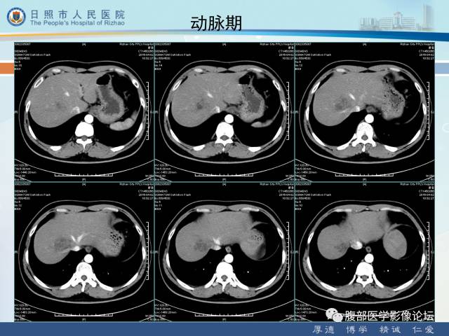 【病例】肝右叶孤立性胆管错构瘤1例CT影像表现 【病例】肝右叶孤立性胆管错构瘤1例CT影像表现