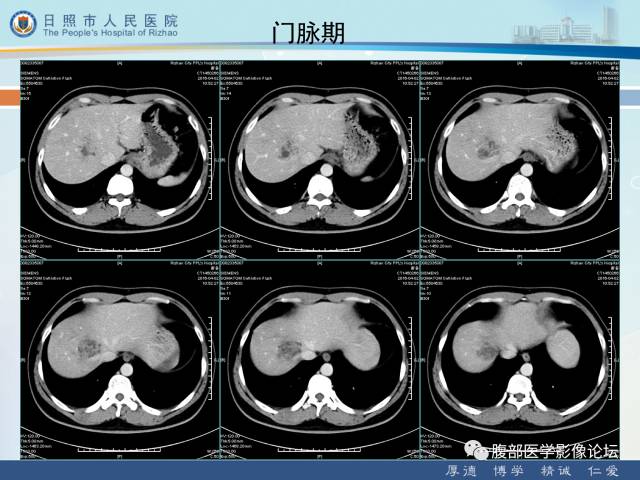 【病例】肝右叶孤立性胆管错构瘤1例CT影像表现 【病例】肝右叶孤立性胆管错构瘤1例CT影像表现