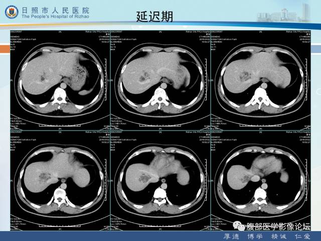 【病例】肝右叶孤立性胆管错构瘤1例CT影像表现 【病例】肝右叶孤立性胆管错构瘤1例CT影像表现