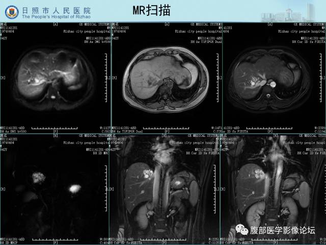 【病例】肝右叶孤立性胆管错构瘤1例CT影像表现 【病例】肝右叶孤立性胆管错构瘤1例CT影像表现