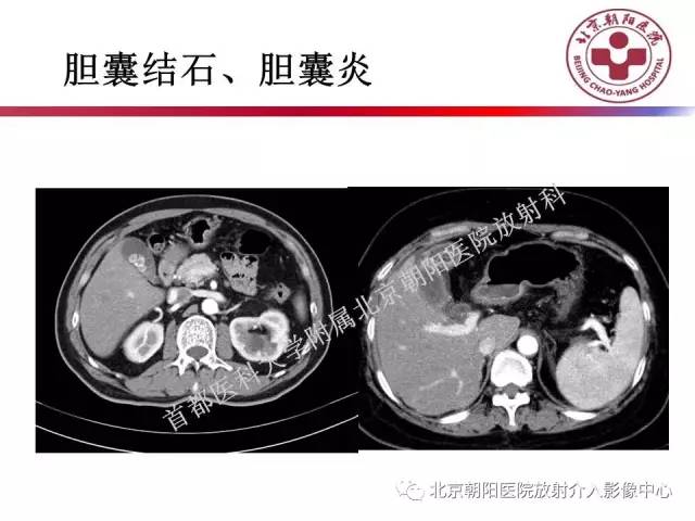 【PPT】急腹症影像诊断思路