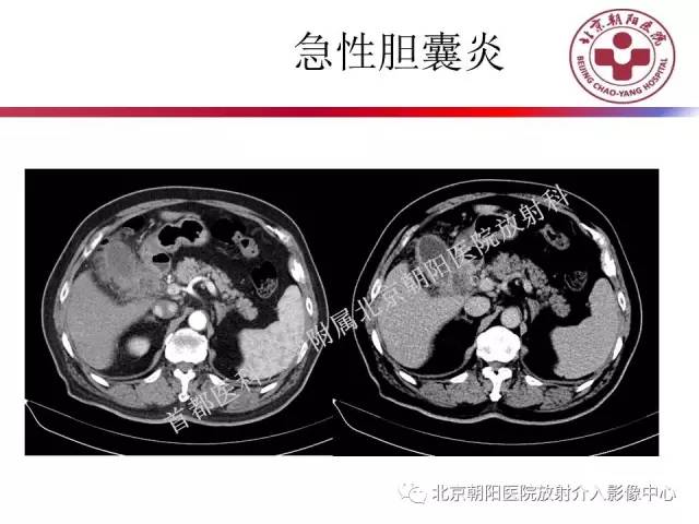【PPT】急腹症影像诊断思路
