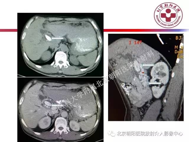 【PPT】急腹症影像诊断思路