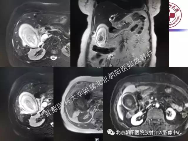 【PPT】急腹症影像诊断思路