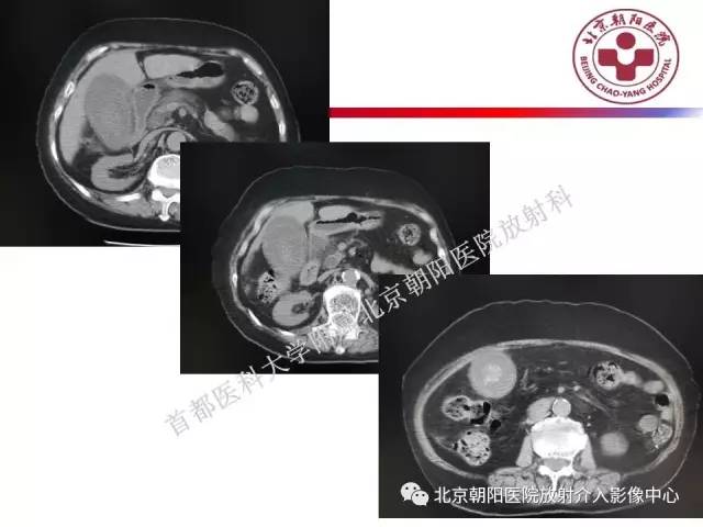 【PPT】急腹症影像诊断思路