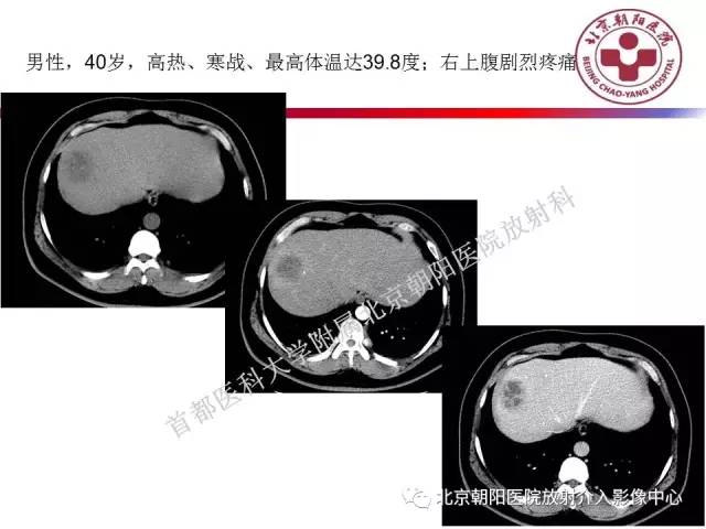 【PPT】急腹症影像诊断思路
