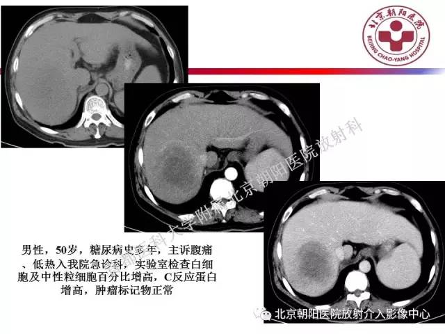 【PPT】急腹症影像诊断思路
