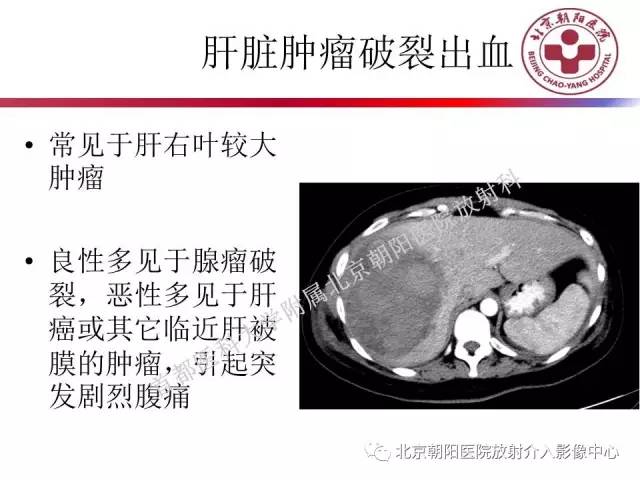 【PPT】急腹症影像诊断思路