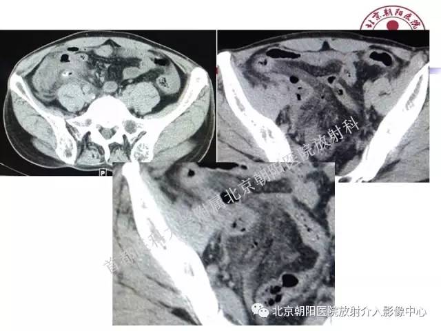 【PPT】急腹症影像诊断思路