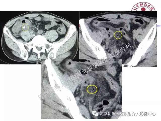 【PPT】急腹症影像诊断思路