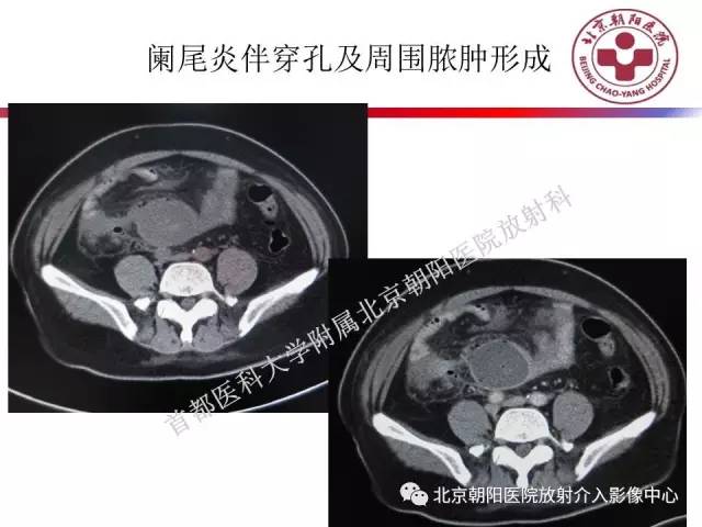 【PPT】急腹症影像诊断思路