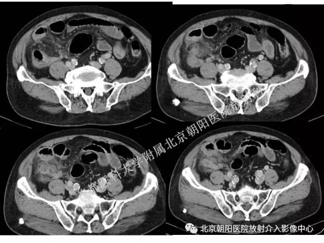 【PPT】急腹症影像诊断思路