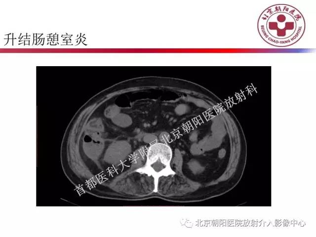 【PPT】急腹症影像诊断思路
