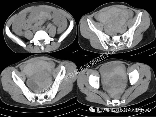 【PPT】急腹症影像诊断思路