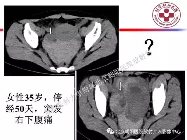 【PPT】急腹症影像诊断思路