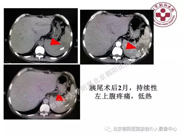 【PPT】急腹症影像诊断思路