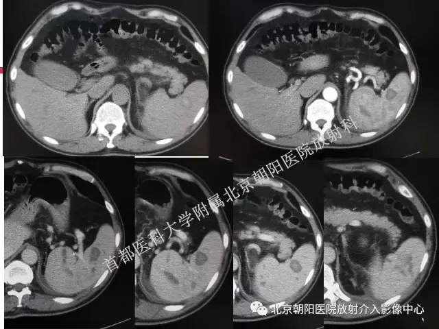 【PPT】急腹症影像诊断思路