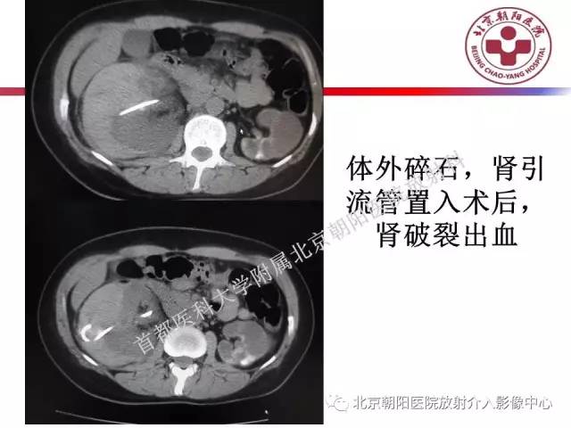 【PPT】急腹症影像诊断思路