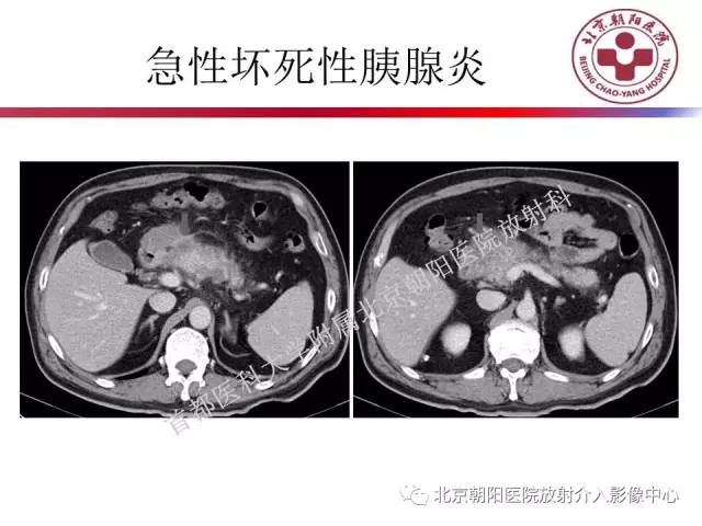 【PPT】急腹症影像诊断思路