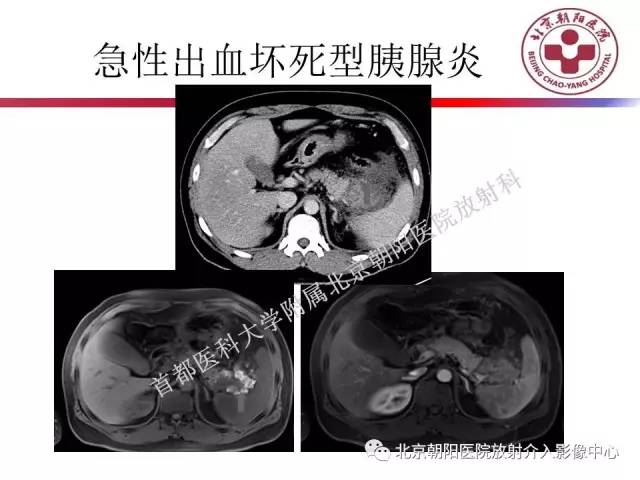【PPT】急腹症影像诊断思路