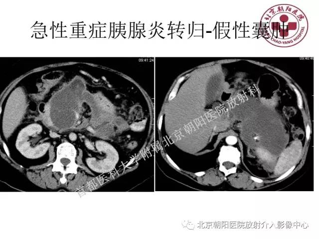 【PPT】急腹症影像诊断思路