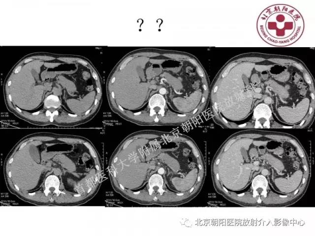 【PPT】急腹症影像诊断思路