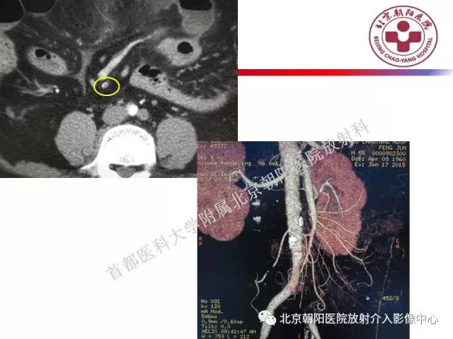 【PPT】急腹症影像诊断思路