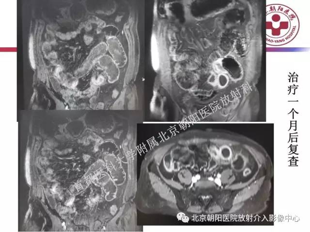 【PPT】急腹症影像诊断思路