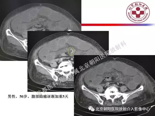 【PPT】急腹症影像诊断思路