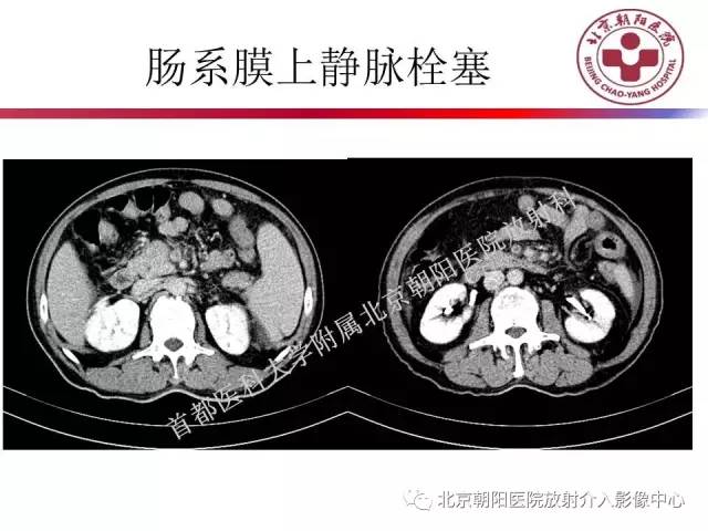 【PPT】急腹症影像诊断思路