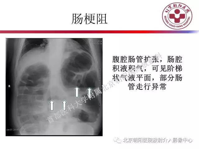 【PPT】急腹症影像诊断思路