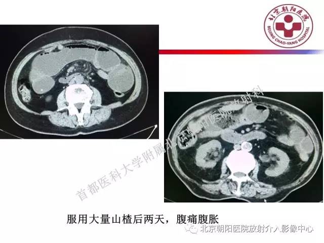 【PPT】急腹症影像诊断思路
